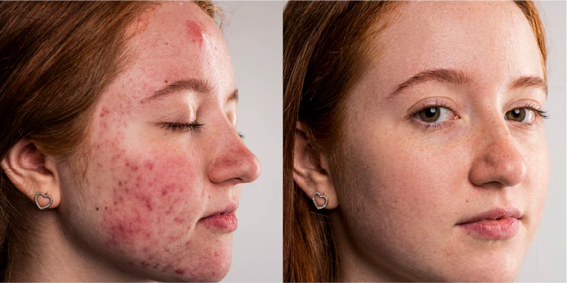 Dull skin concern