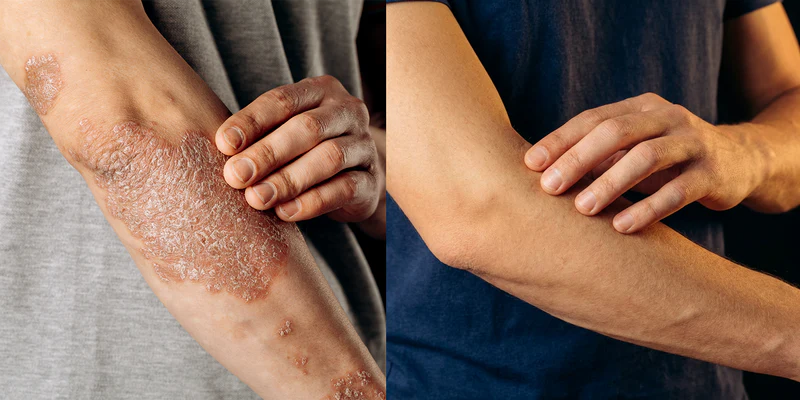Sensitive skin concern